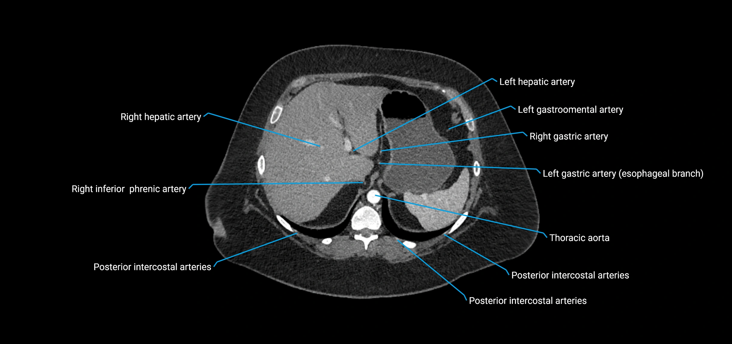 CTA abdomen axial cross sectional anatomy labelled image_36 (2).webp